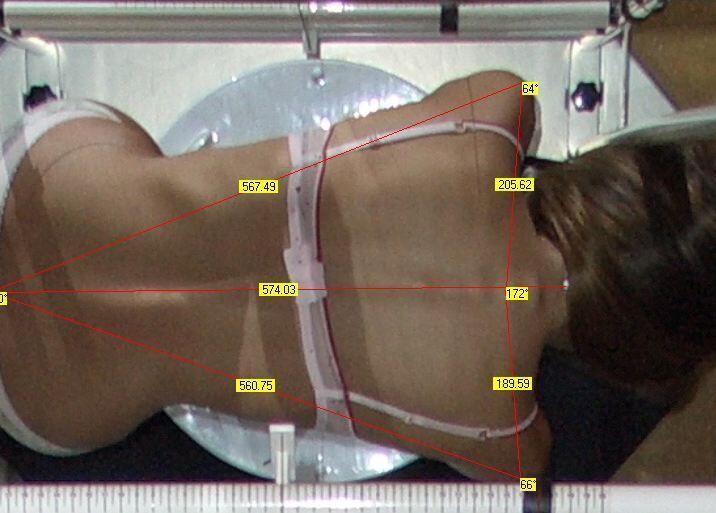 Valutazione sul lettino Fisiofeedback per scoliosi e asimmetrie